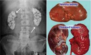 Kidney Renal Failure kidney failure cure